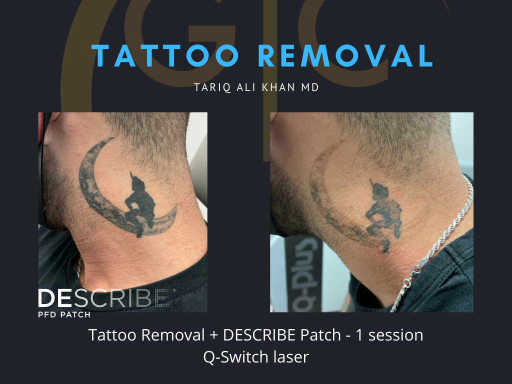 Gentle Care Laser Tustin & Long Beach Before and After picture - Tattoo Removal Mucosal Surface